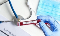 Քորոնա Ժահրը Հայաստանի Մէջ. Վարակուածներուն Թիւը Հասաւ 78-ի